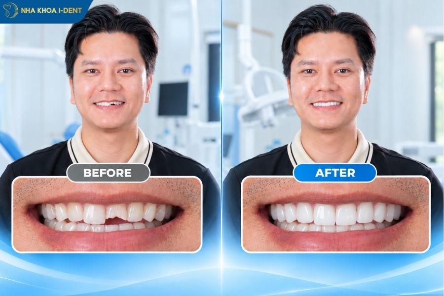 gãy răng cửa có ảnh hưởng gì không - Nha khoa I-Dent