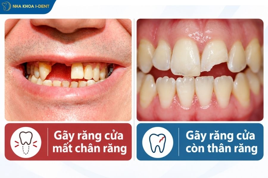 gãy răng cửa - Nha khoa I-Dent