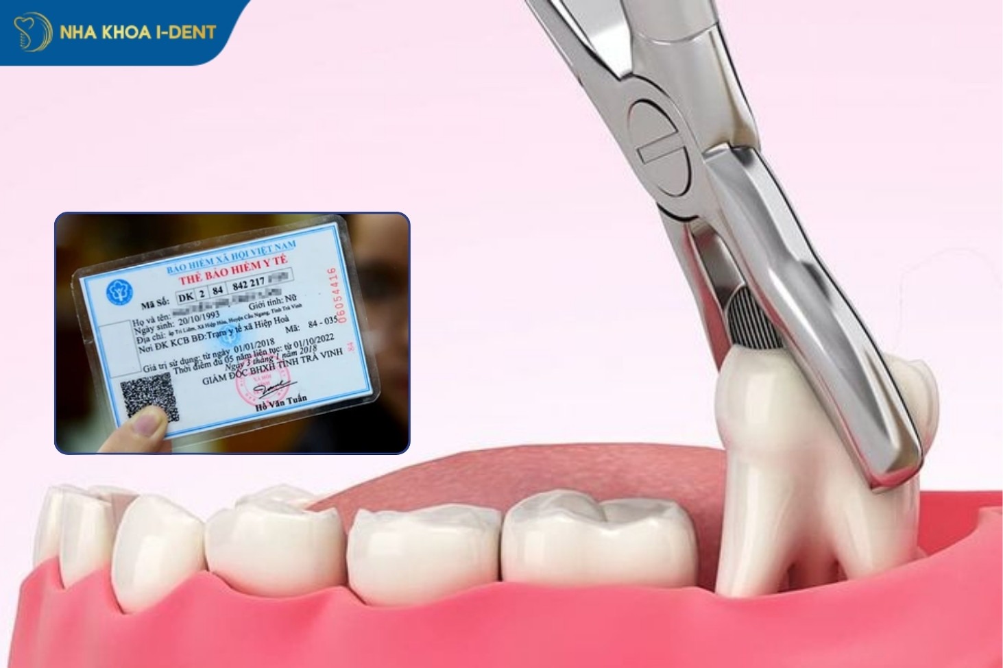 giá nhổ răng khôn bảo hiểm y tế