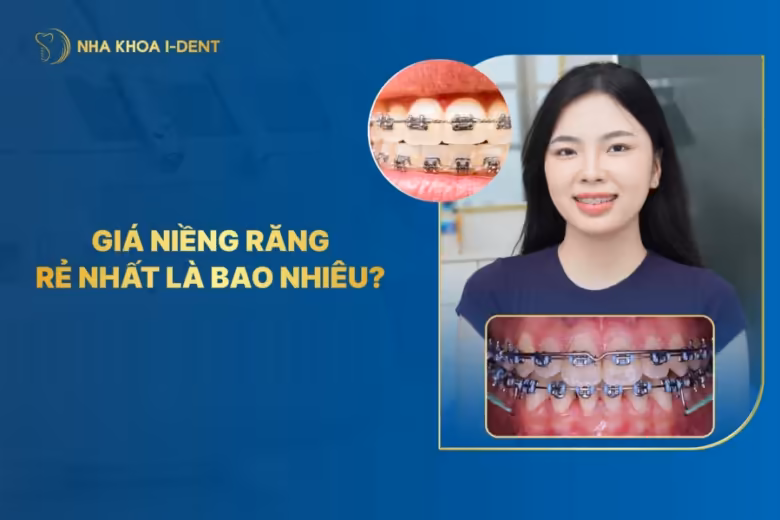 giá niềng răng rẻ nhất