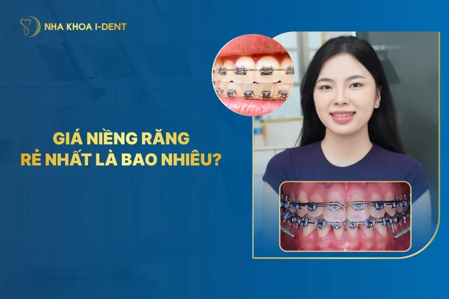 giá niềng răng rẻ nhất