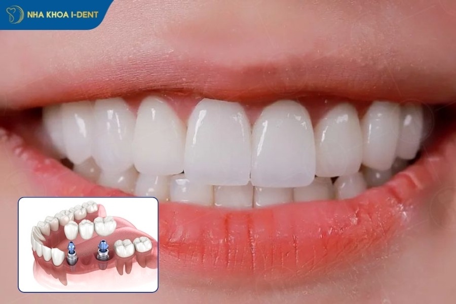 Giá trồng răng sứ 1 chiếc