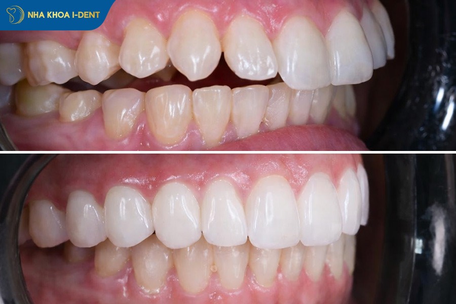 hình ảnh bọc răng sứ