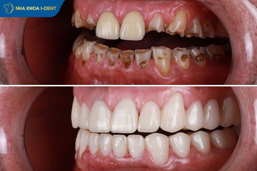 hình ảnh răng sứ đẹp