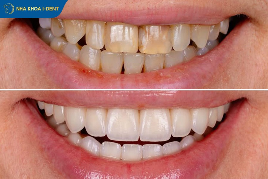 hình ảnh răng sứ