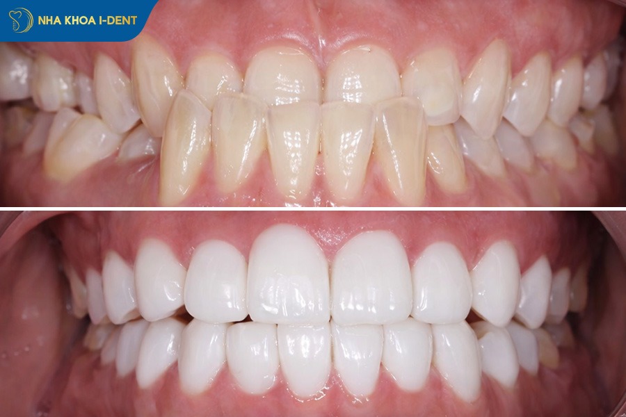 hình ảnh trước và sau khi làm răng sứ