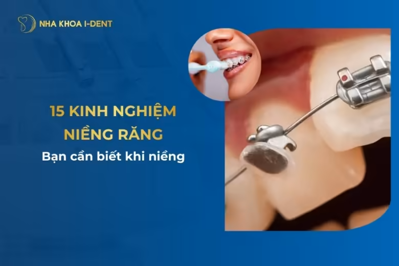 kinh nghiệm niềng răng