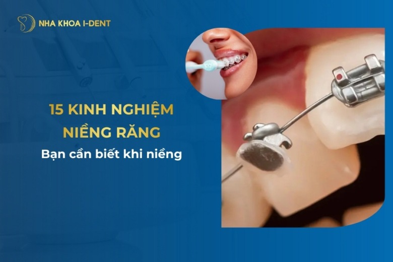 15 kinh nghiệm niềng răng bạn cần biết khi niềng
