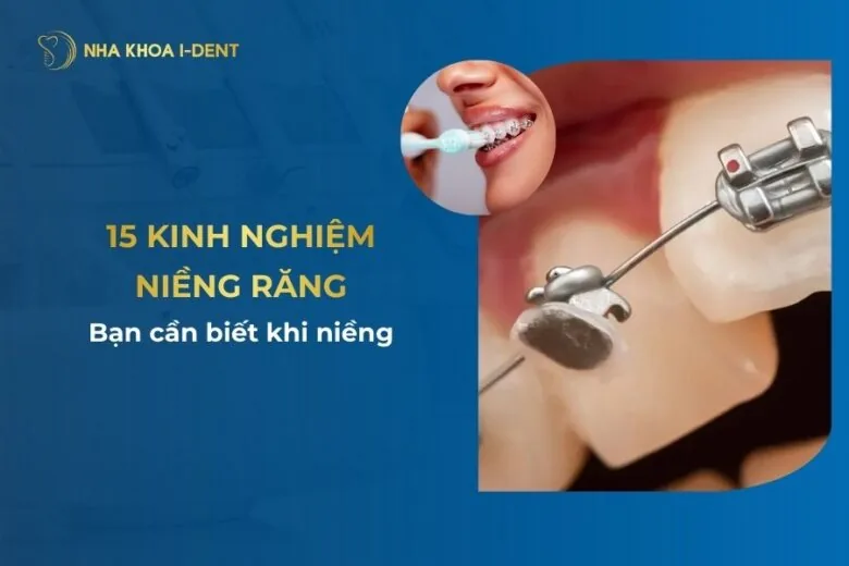 kinh nghiệm niềng răng