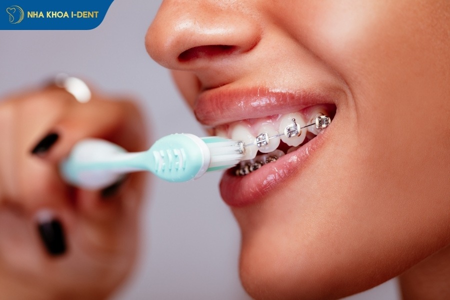 kinh nghiệm niềng răng cho trẻ