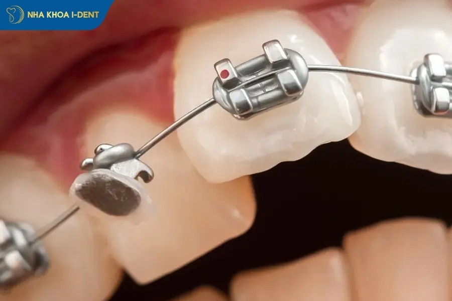 kinh nghiệm niềng răng không mắc cài