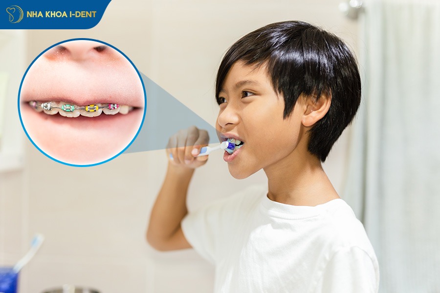 lưu ý khi niềng răng cho bé 9 tuổi