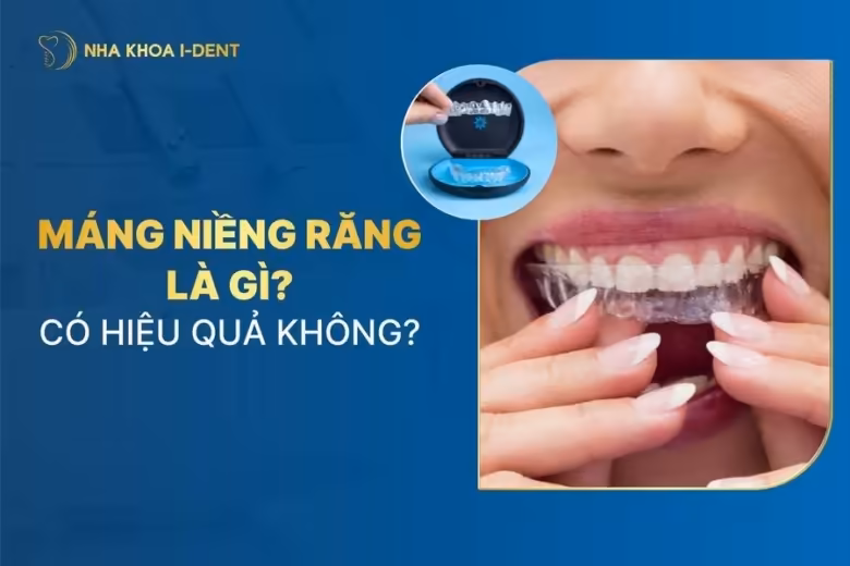 máng niềng răng