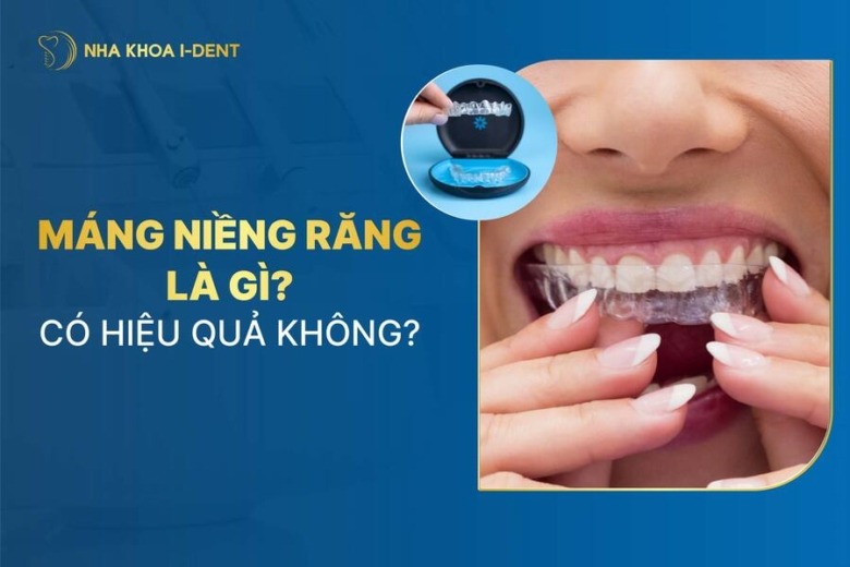Máng niềng răng là gì? Có hiệu quả không?
