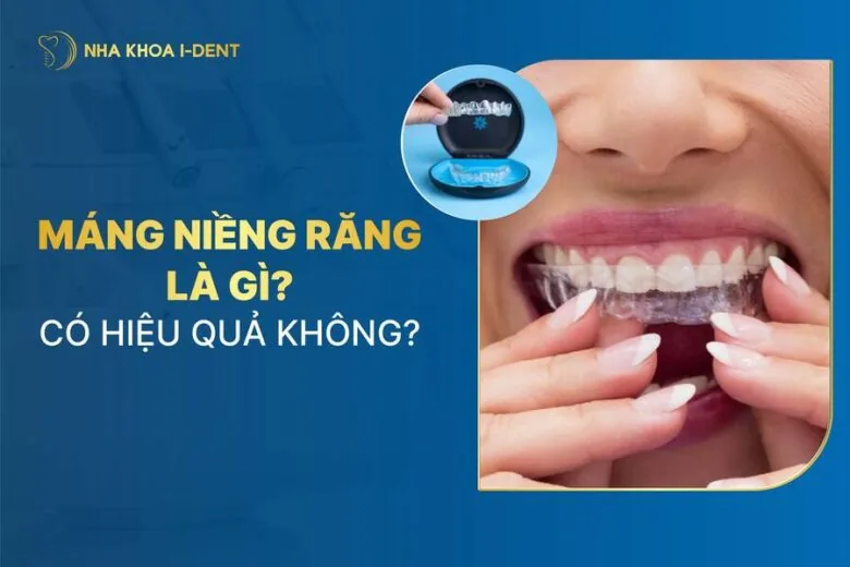 máng niềng răng