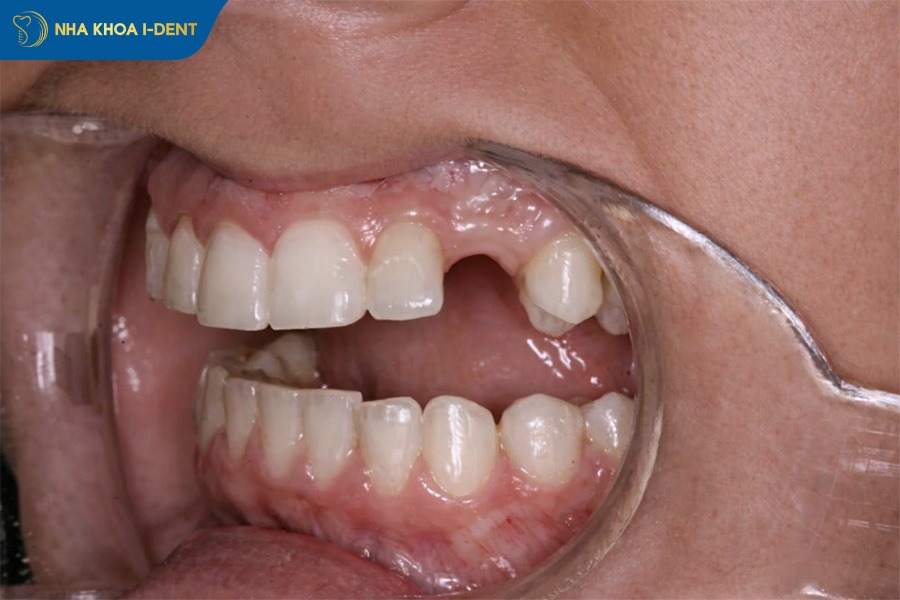 Mất răng số 3 gây tiêu xương hàm