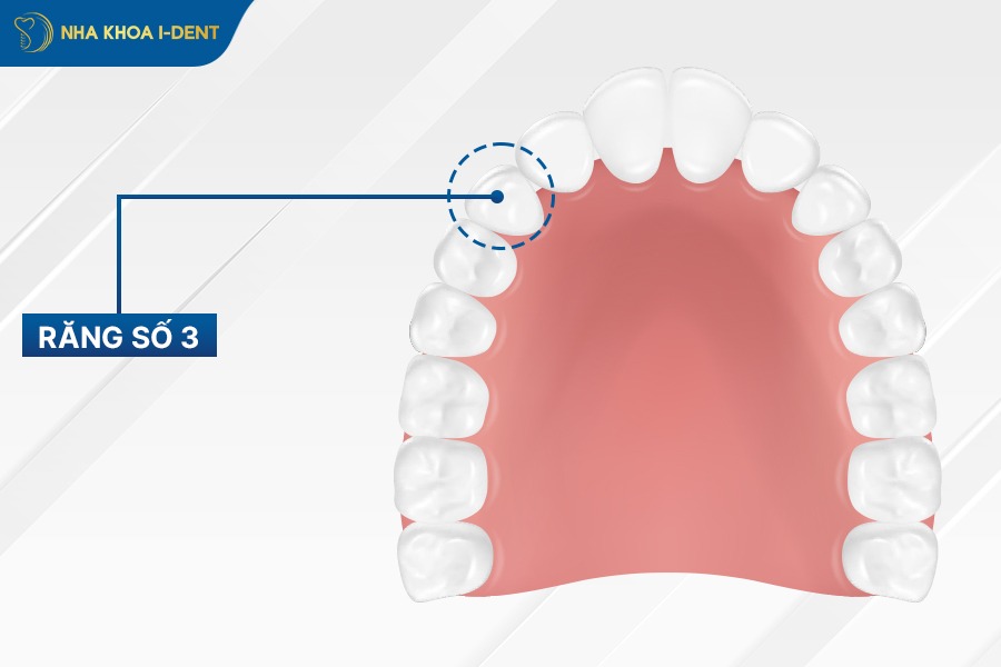 mất răng số 3 hàm trên