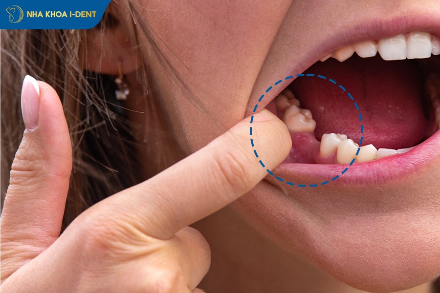 mất răng số 5 hàm trên