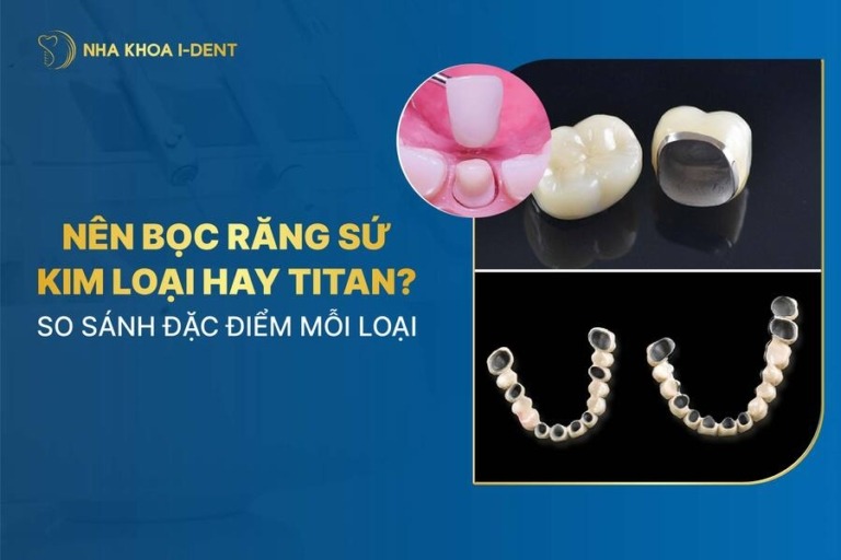 nên bọc răng sứ kim loại hay titan