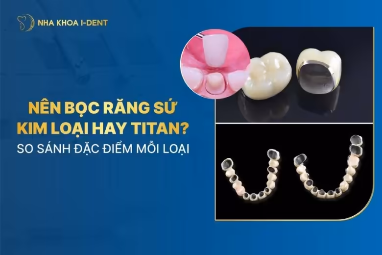 nên bọc răng sứ kim loại hay titan