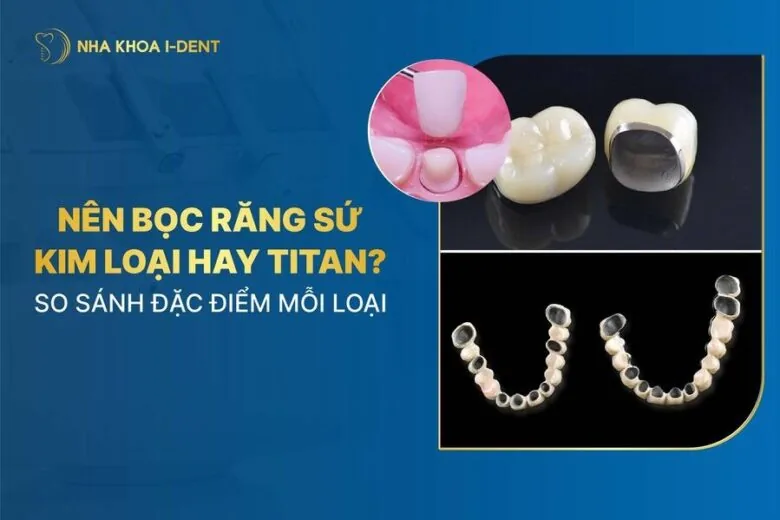 nên bọc răng sứ kim loại hay titan