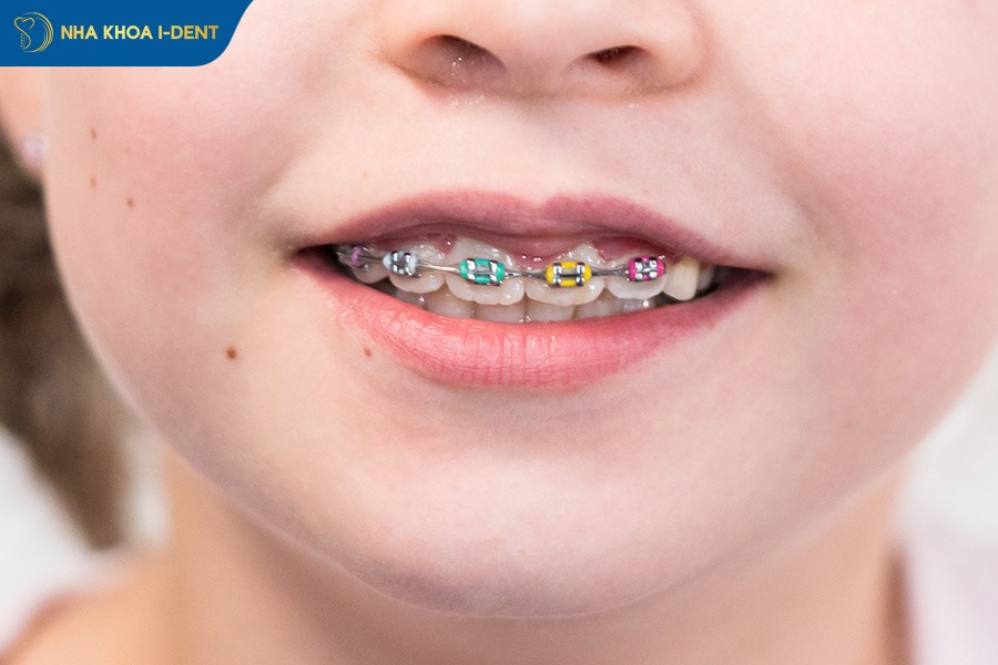 nên niềng răng cho bé 7 tuổi