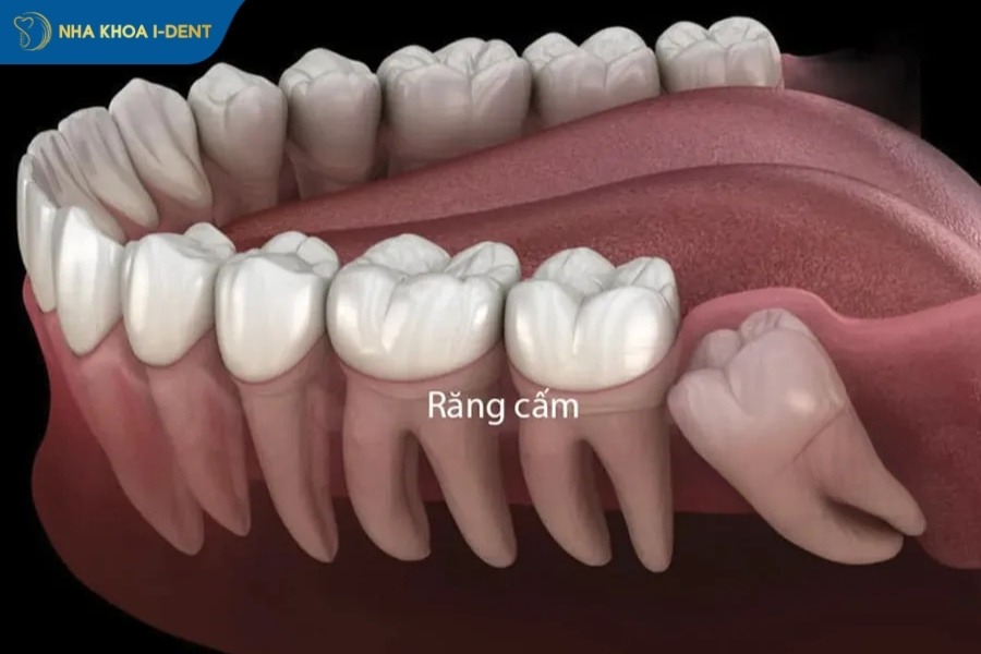 nhổ răng cấm bao nhiêu tiền
