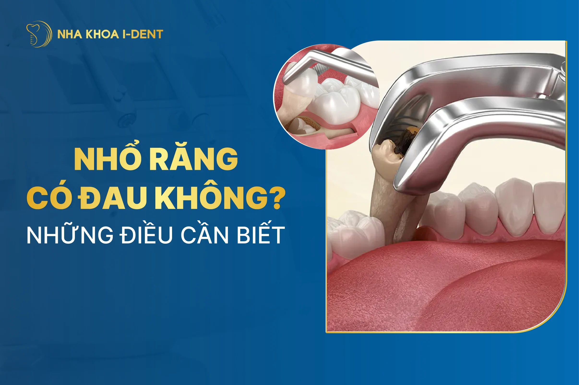 Nhổ răng có đau không? Lưu ý trước và sau khi nhổ răng