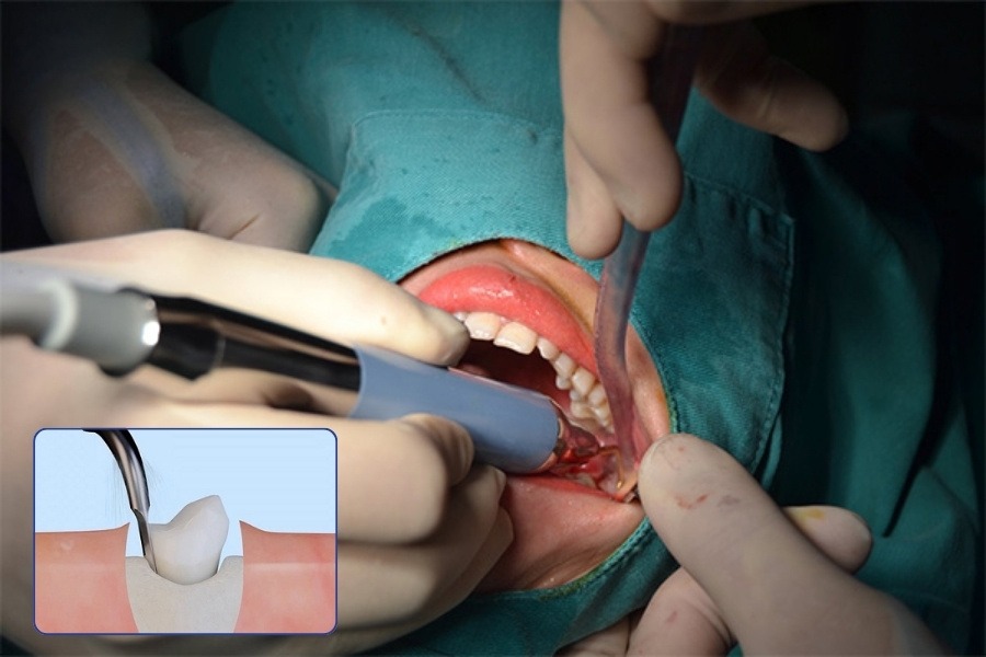 nhổ răng khôn có nguy hiểm không