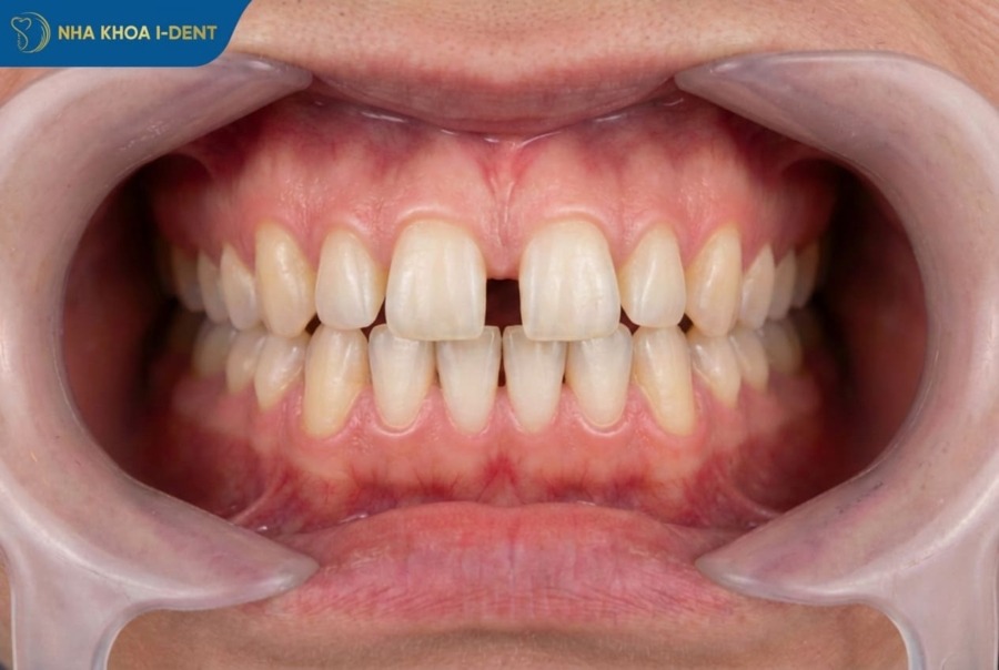 niềng 2 răng cửa bị thưa