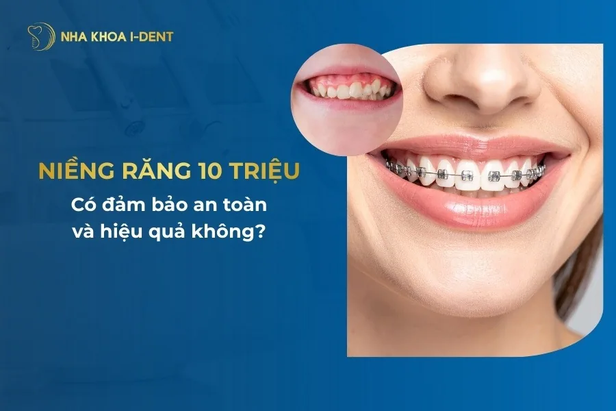 niềng răng 10 triệu
