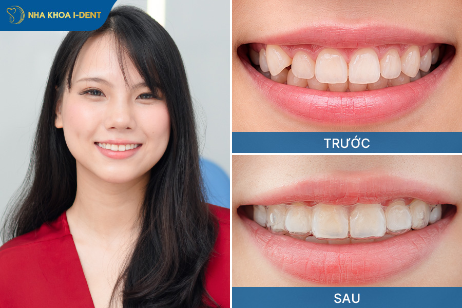 niềng răng bao nhiêu tiền 2 hàm