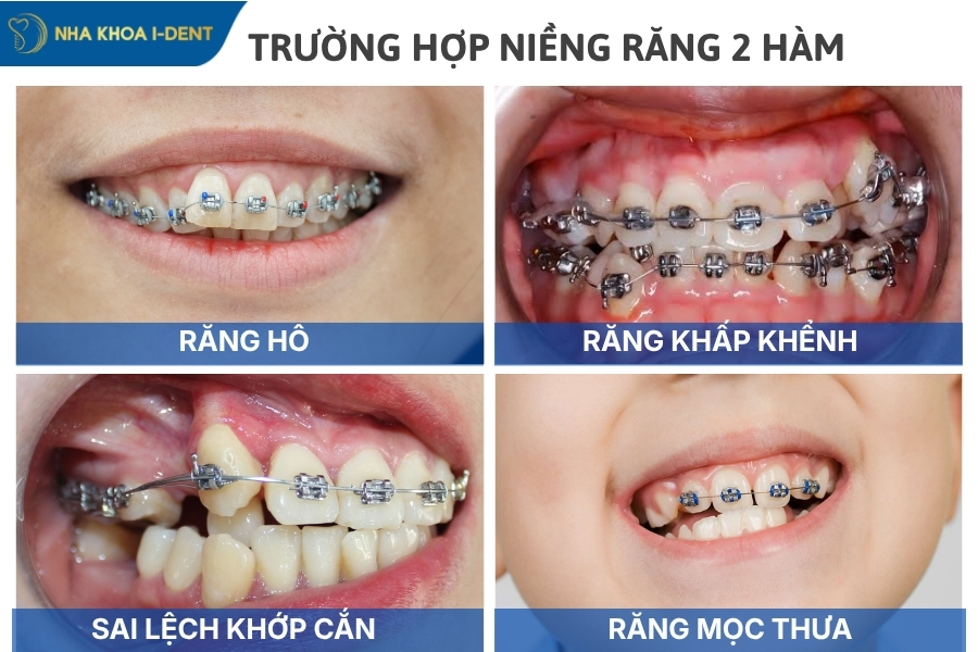 giá niềng răng 2 hàm