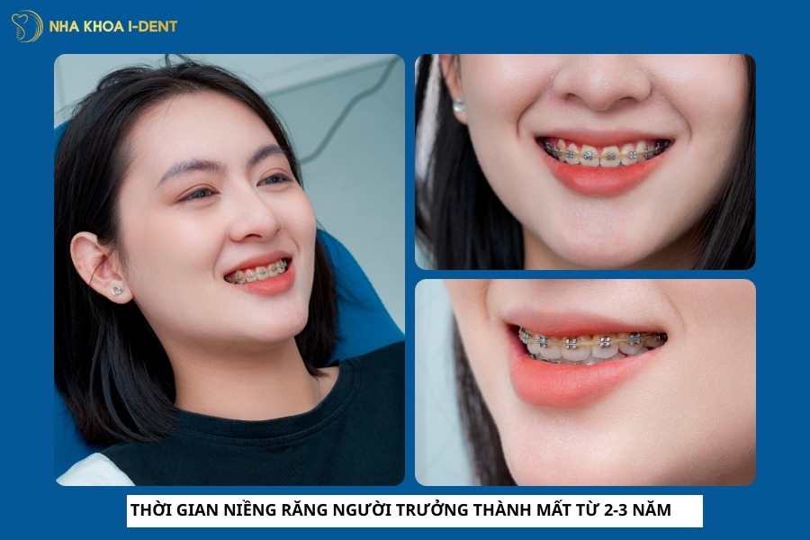 niềng răng bao lâu thì xong