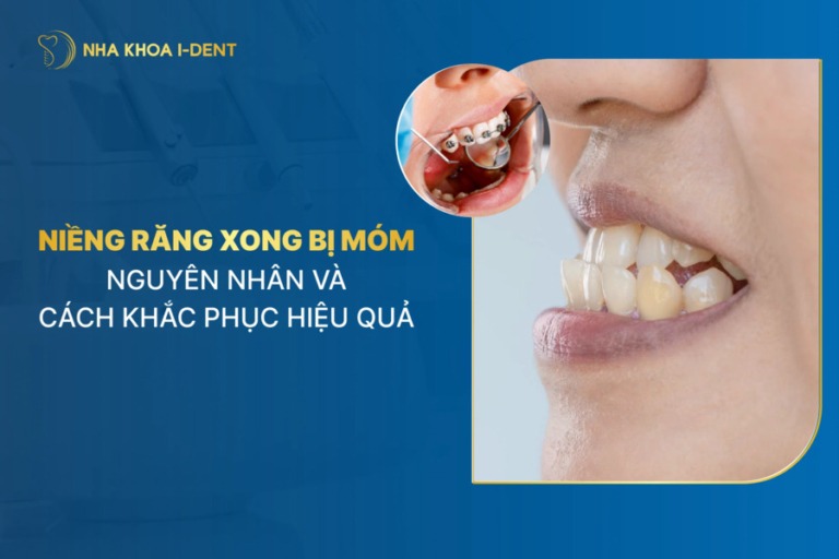 niềng răng bị móm