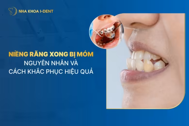 niềng răng bị móm