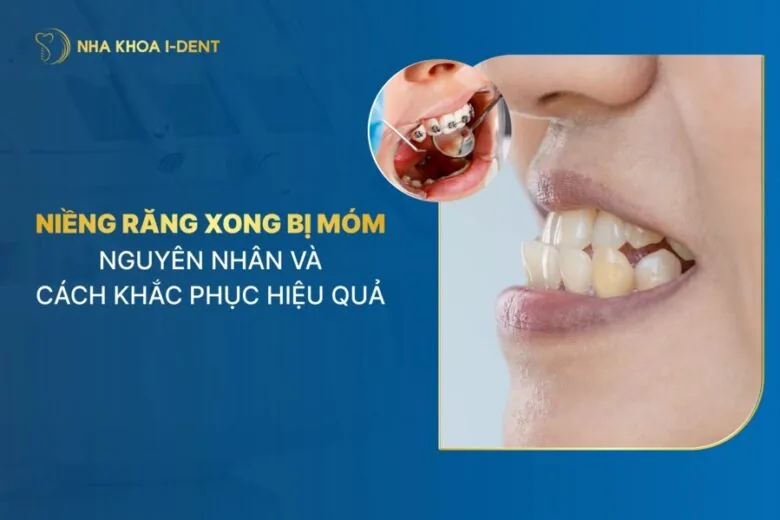 niềng răng bị móm