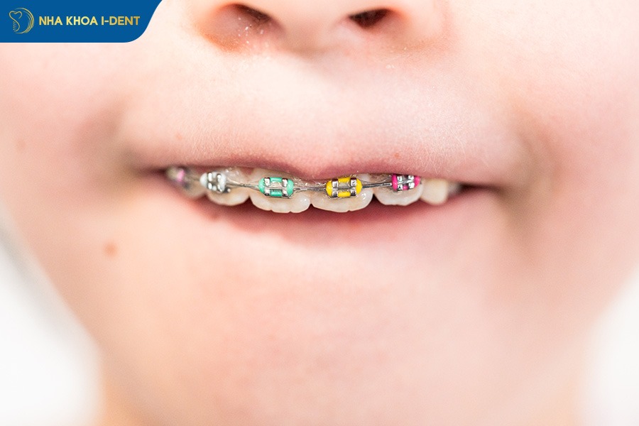 Niềng răng cho bé 7 tuổi bằng mắc cài kim loại