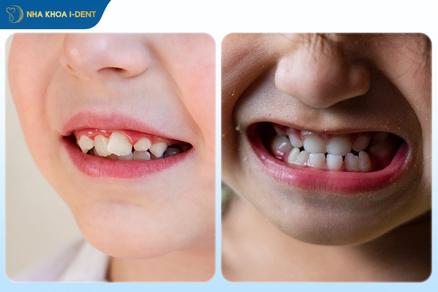 Niềng răng hô và móm cho bé