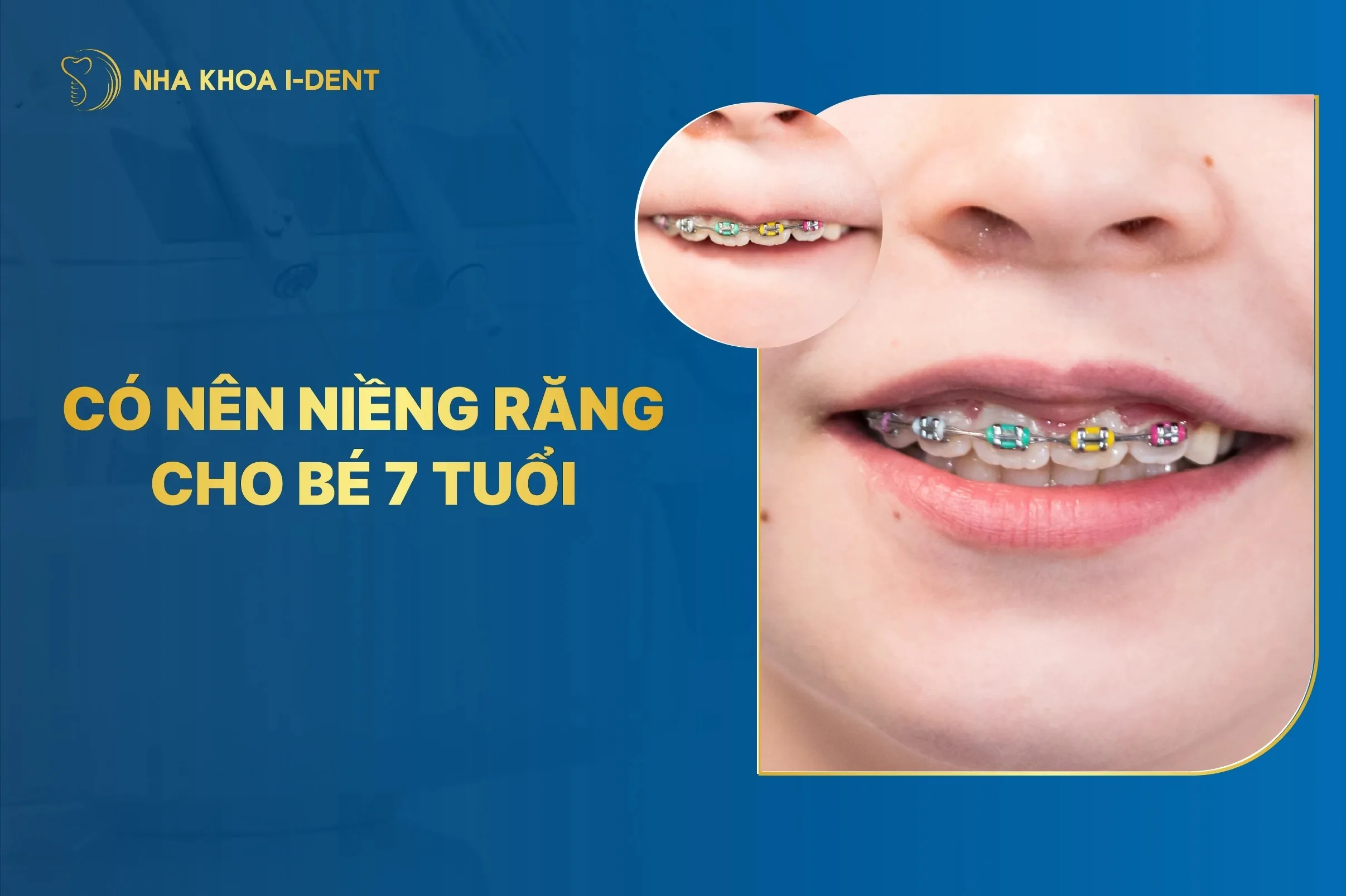 Có Nên Niềng Răng Cho Bé 7 Tuổi? Tại Sao Nên Niềng?