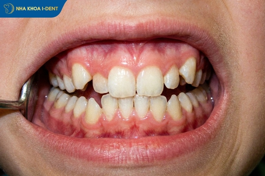 niềng răng cho bé khi răng mọc lệch và khấp khênh