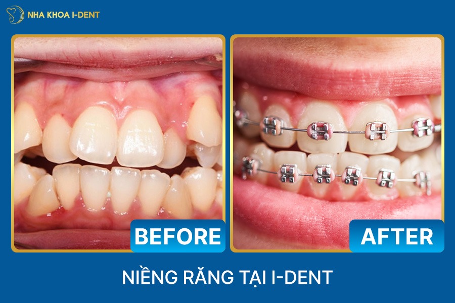 niềng răng cho trẻ 9 tuổi