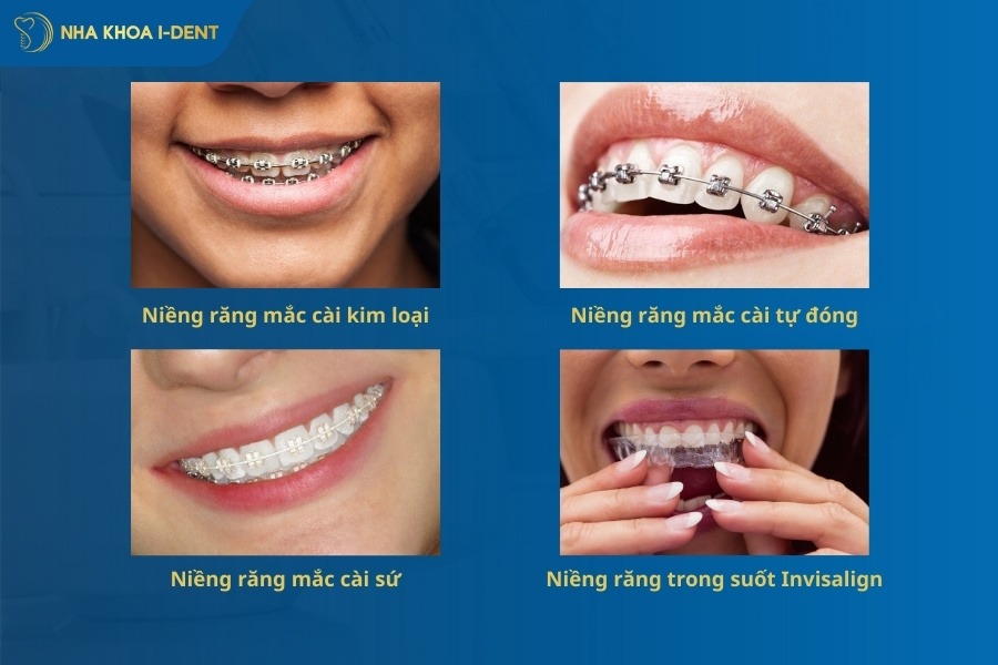 niềng răng cửa