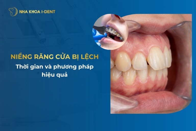 niềng răng cửa bị lệch