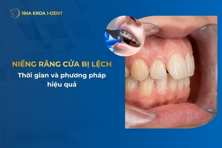 niềng răng cửa bị lệch