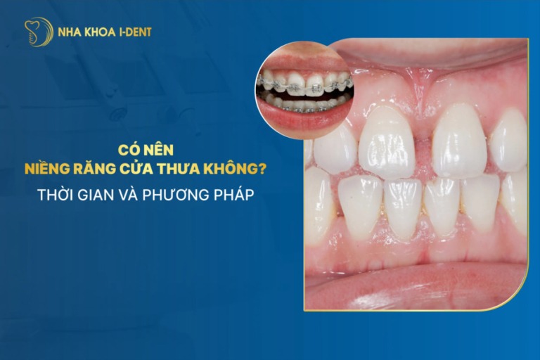 niềng răng cửa thưa