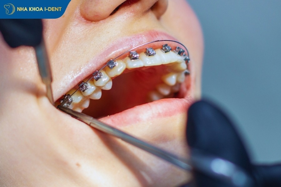 niềng răng đau nhất giai đoạn nào