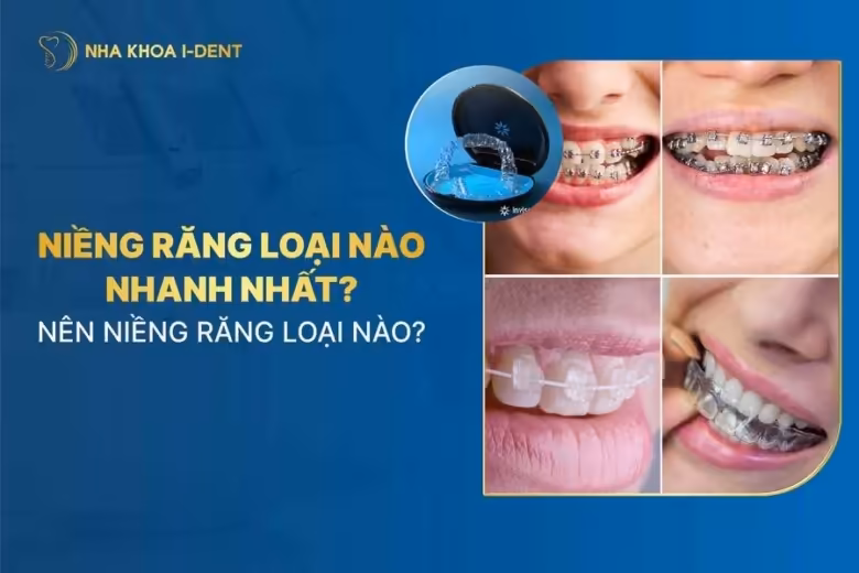 niềng răng loại nào nhanh nhất