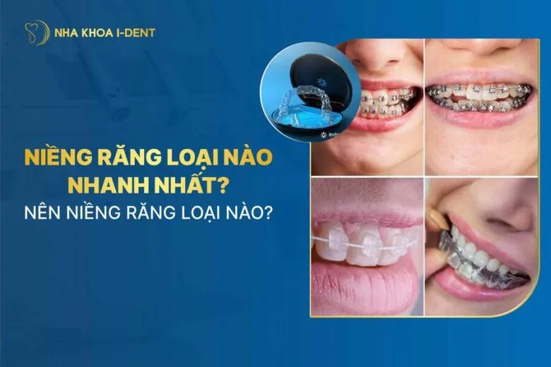 niềng răng loại nào nhanh nhất