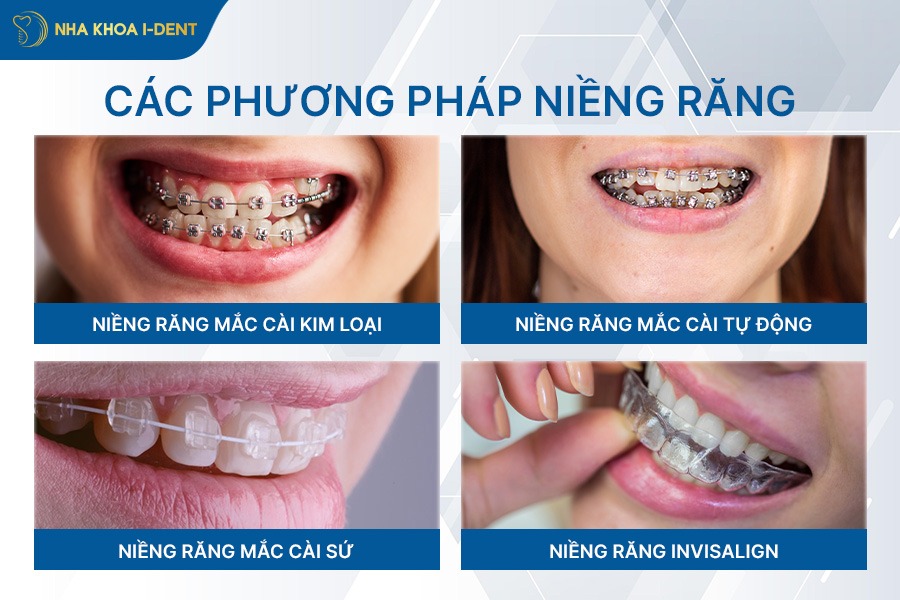 niềng răng loại nào tốt nhất